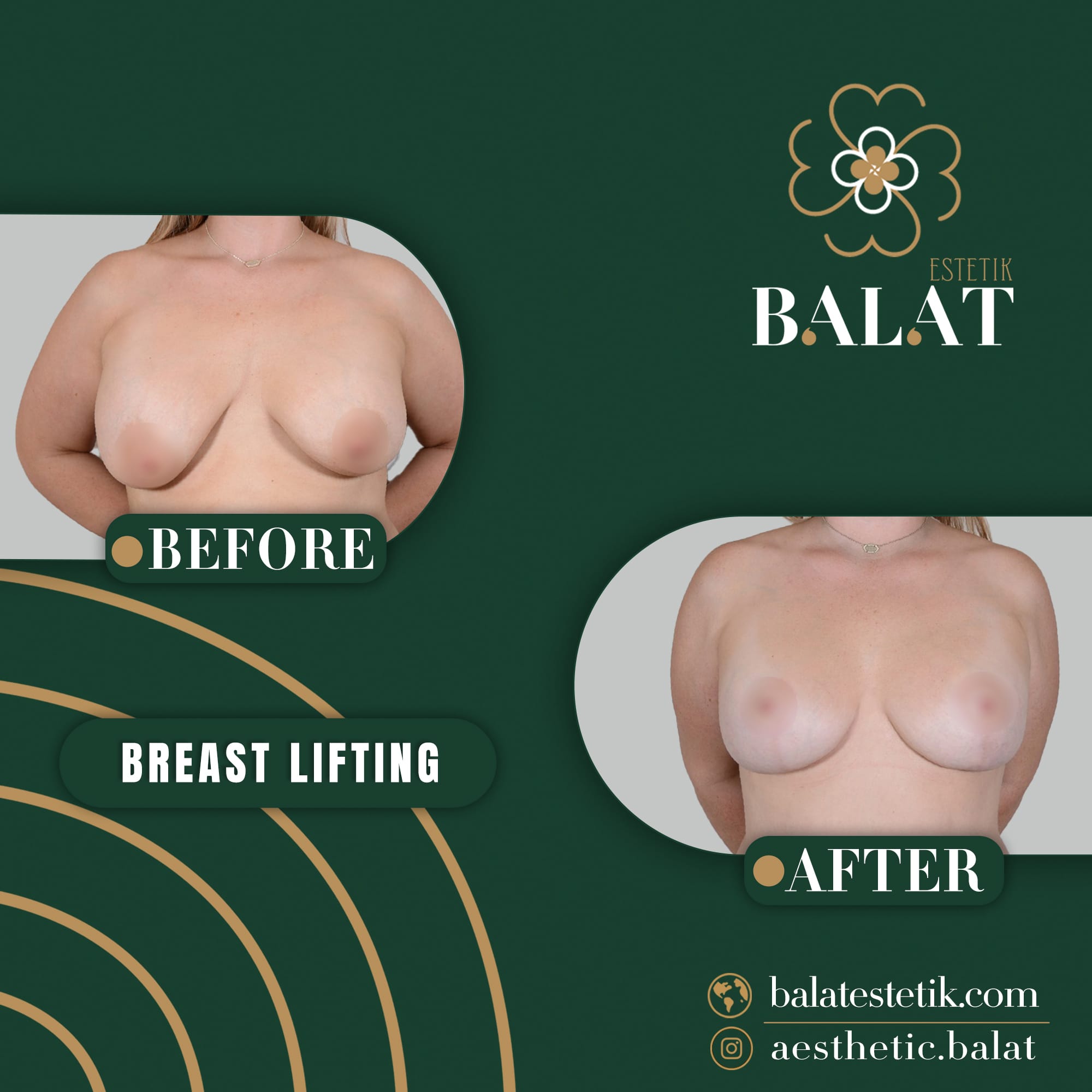 Breast Lifting 1
