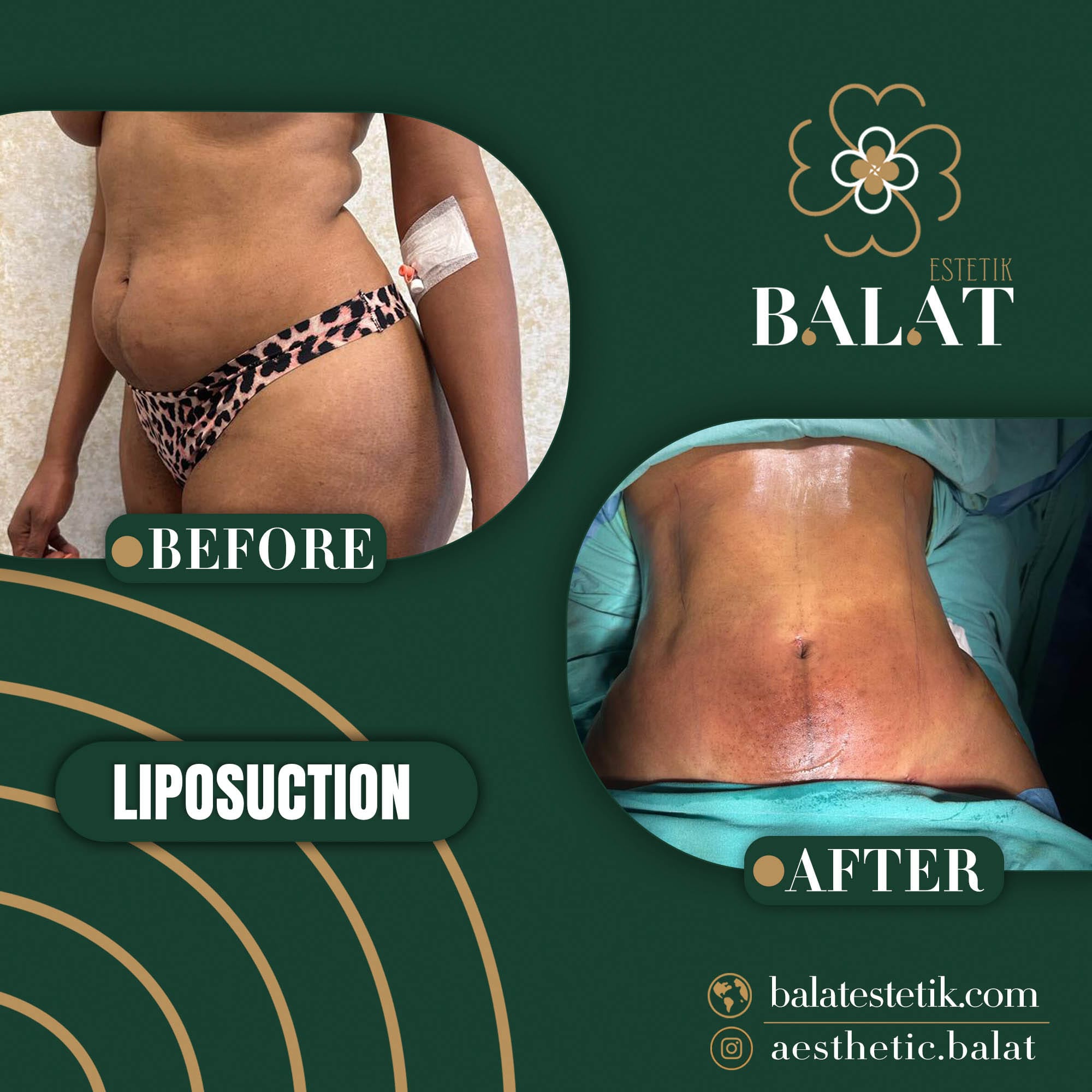 Liposuction 1