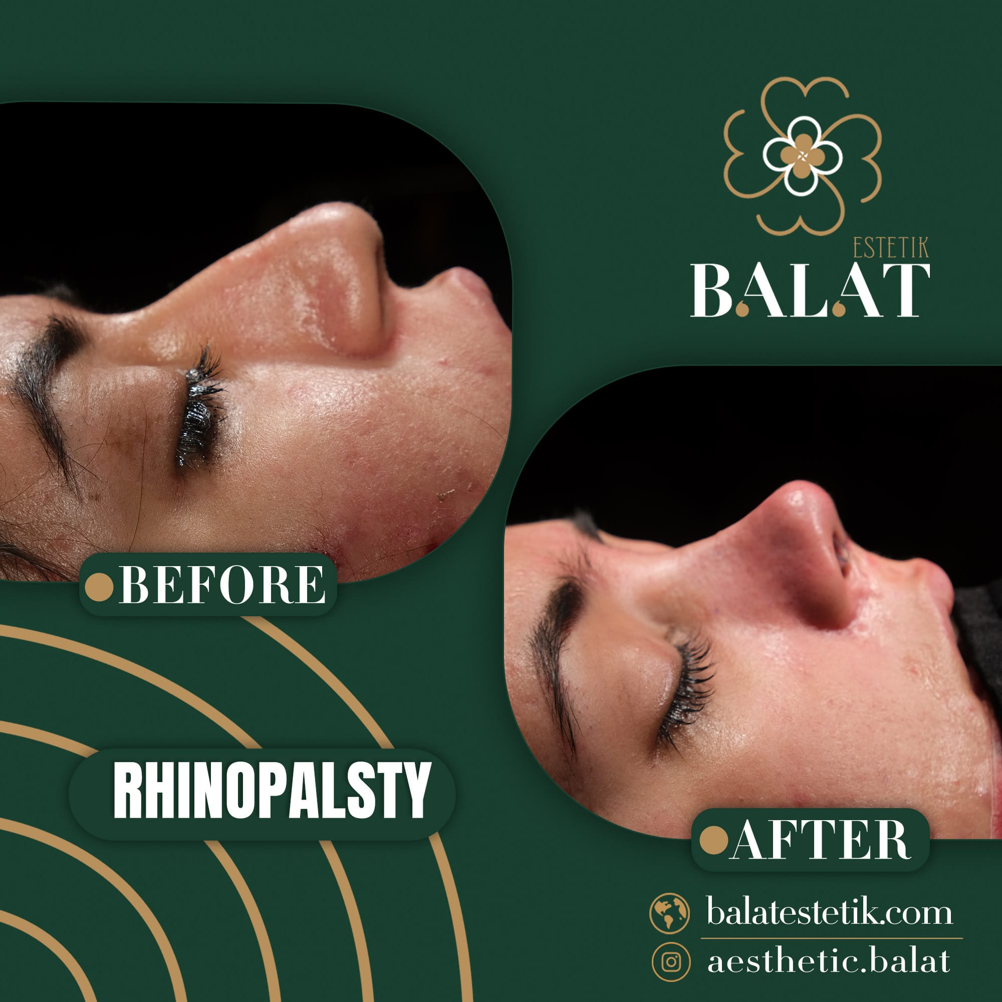 Rhinoplasty 10