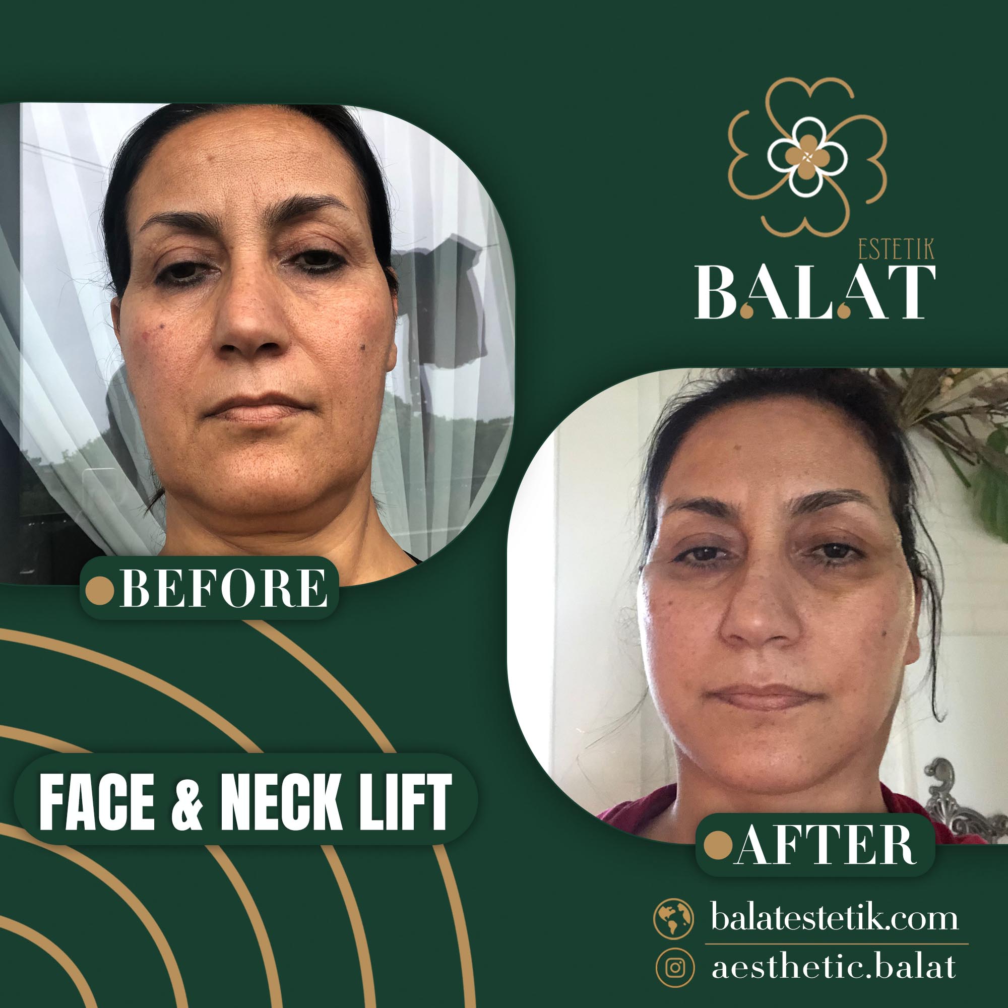 Face Lifting 13