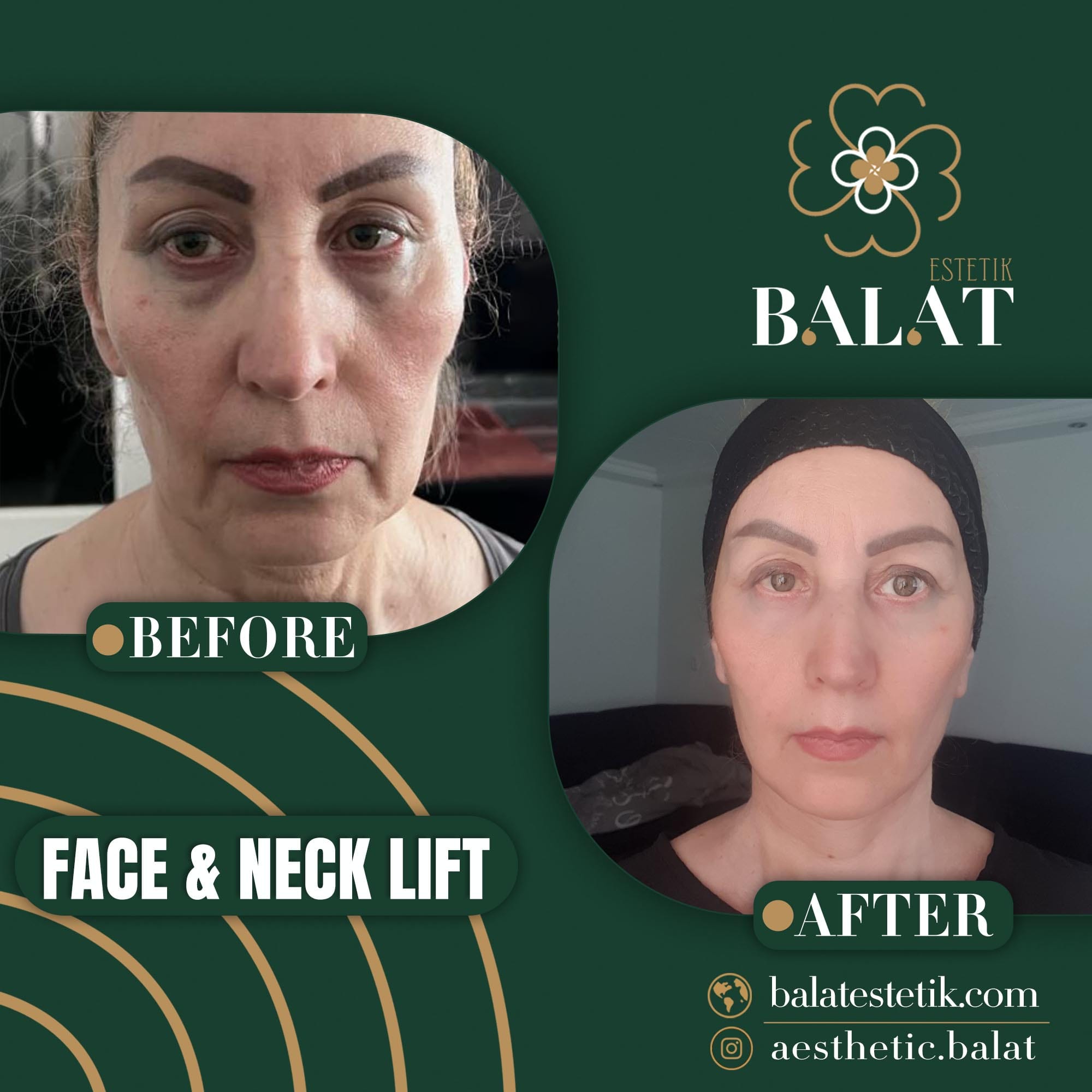 Face Lifting 15
