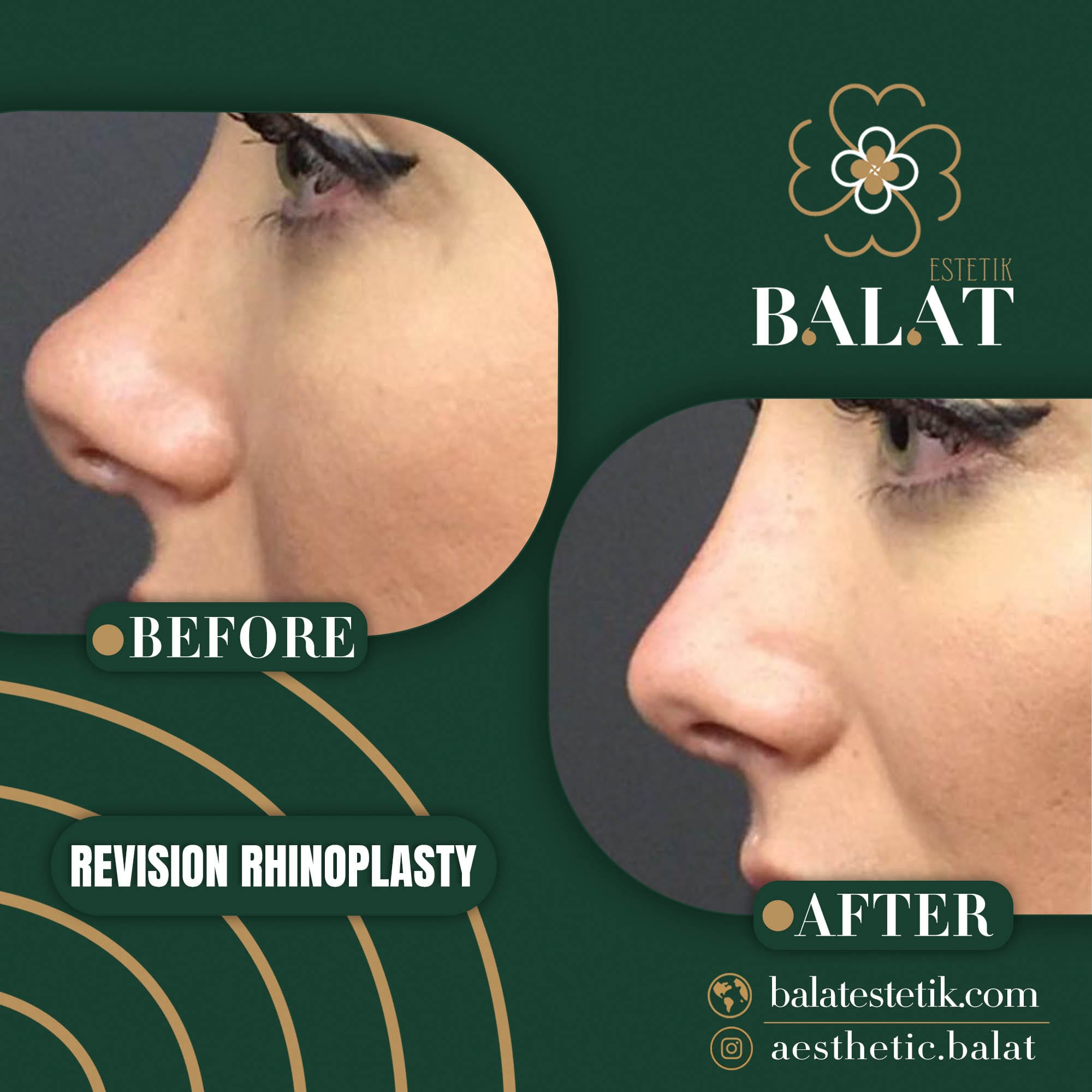 Rhinoplasty 15