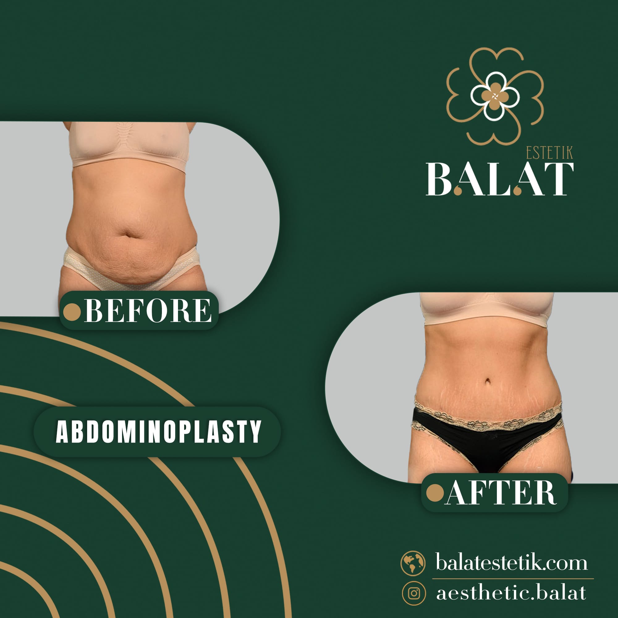 Abdominoplasty 1