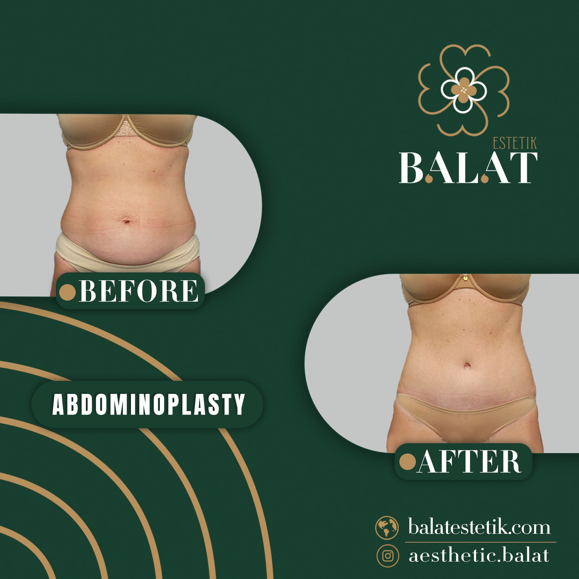 Abdominoplasty 2