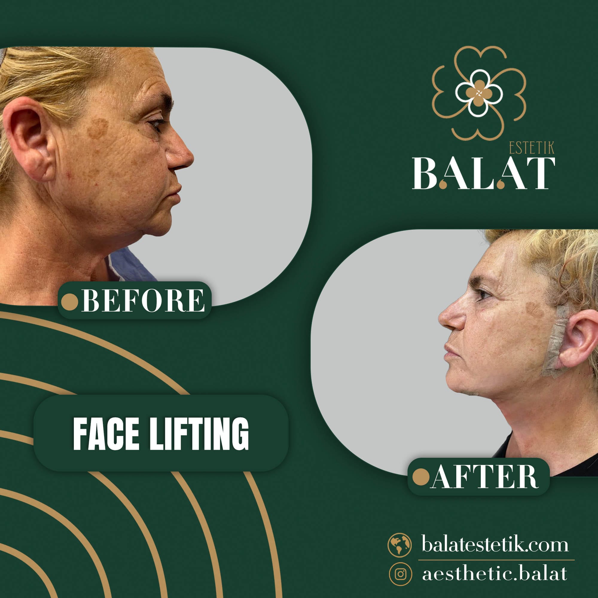 Face Lifting 4