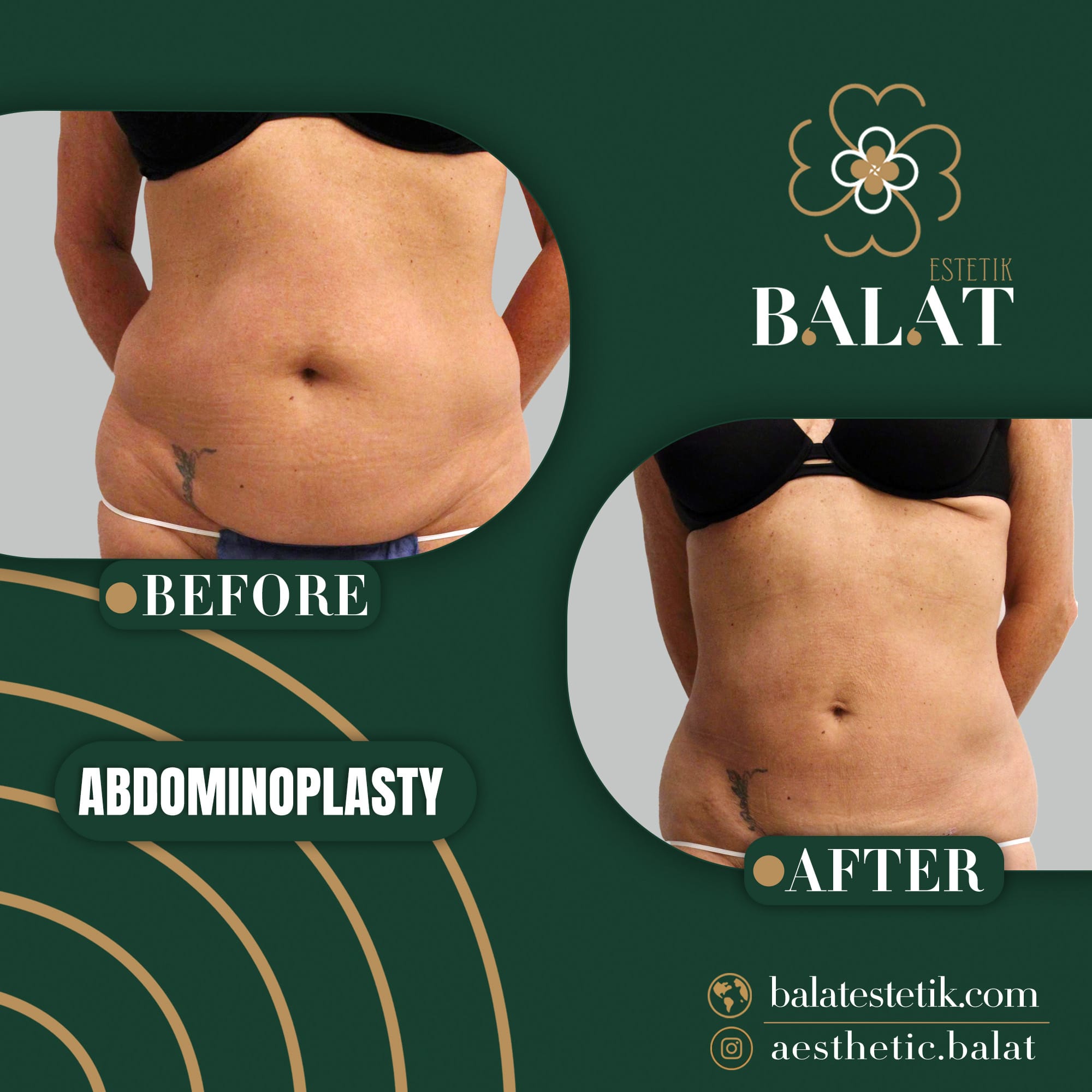 Abdominoplasty 3