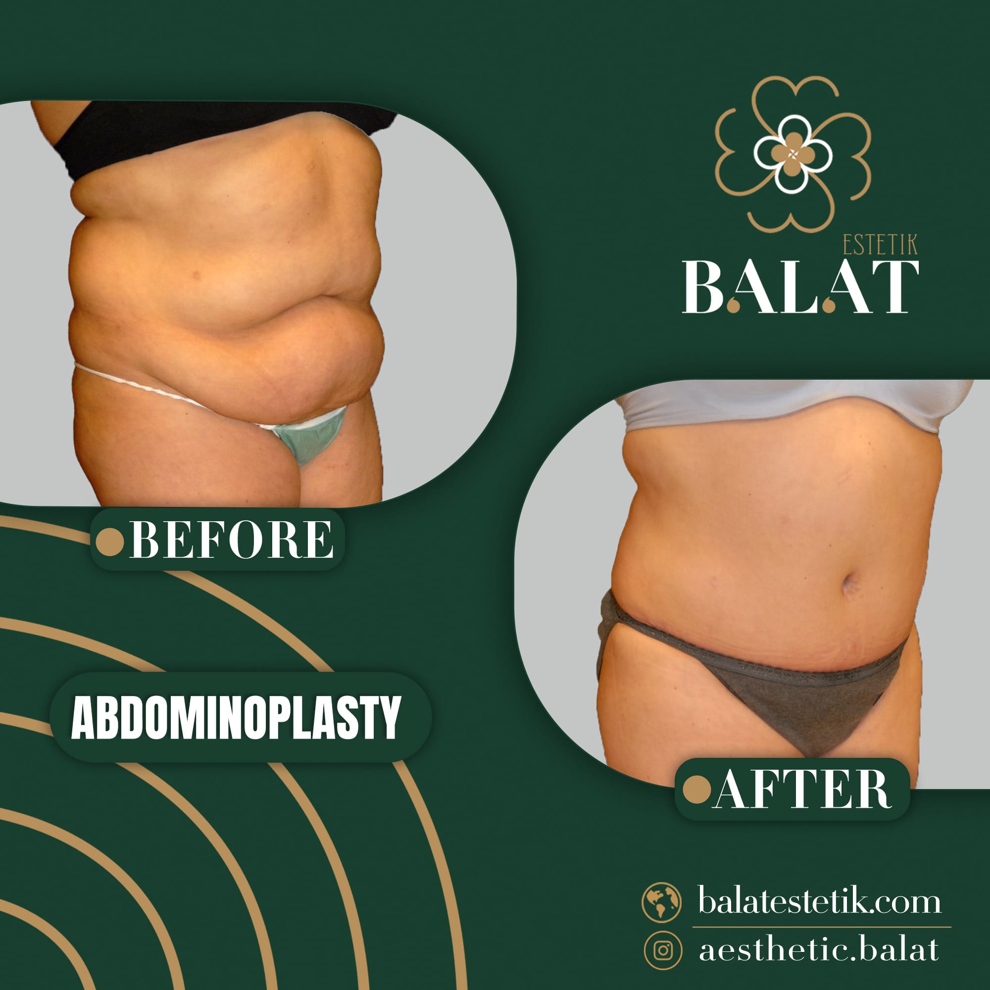 Abdominoplasty 4
