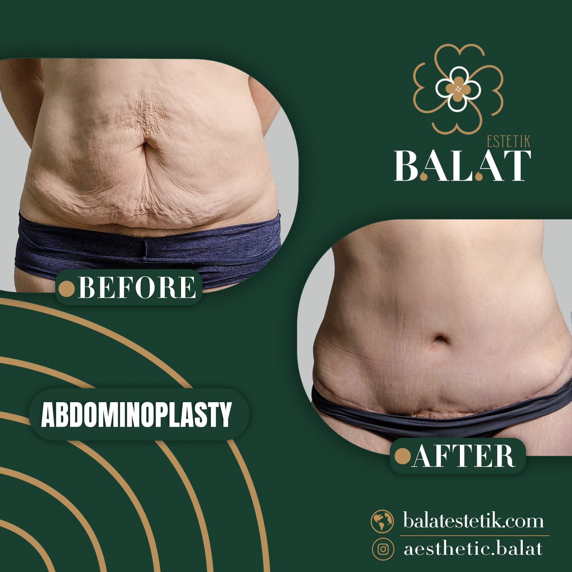 Abdominoplasty 5