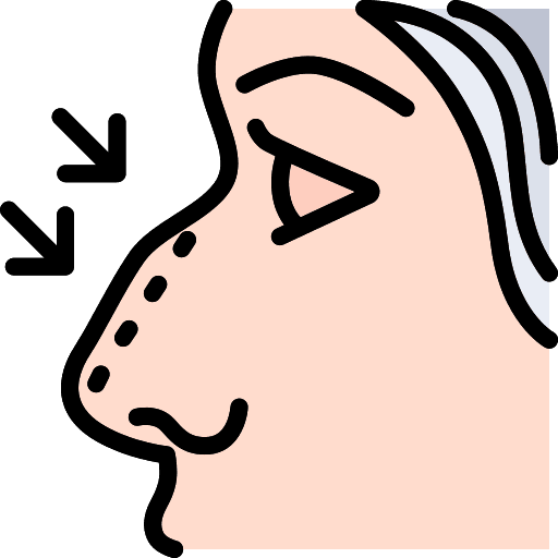 Rhinoplasty